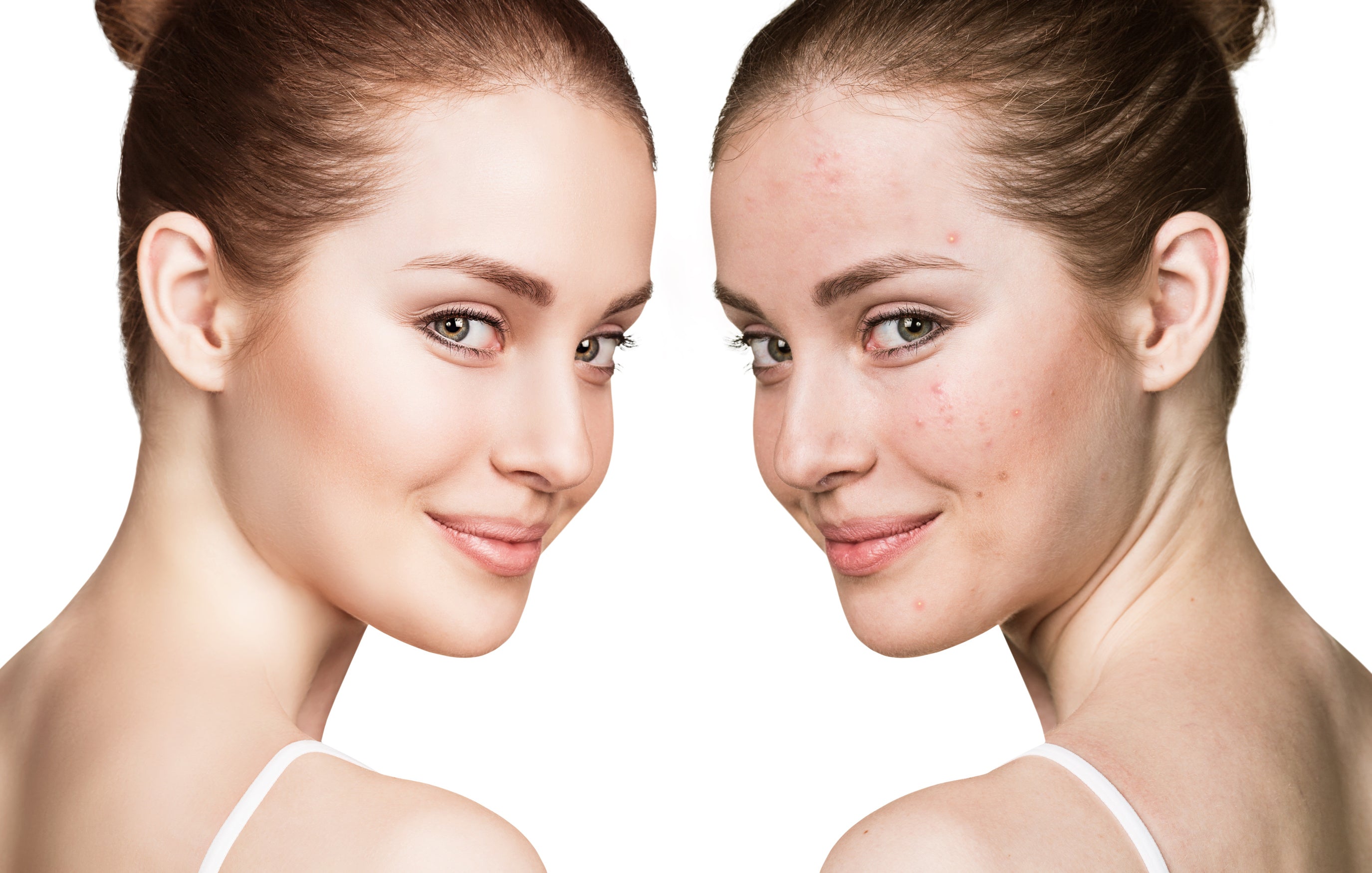 Young woman with and without acne - Soap.Club